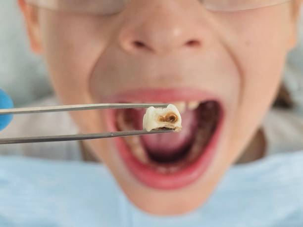 Best Knocked-Out Tooth (Avulsed Tooth) Treatment in Blaine, TN
